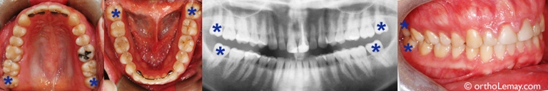 Most people have 32 teeth by the time they are done growing, but wisdom teeth are often removed before they come in.