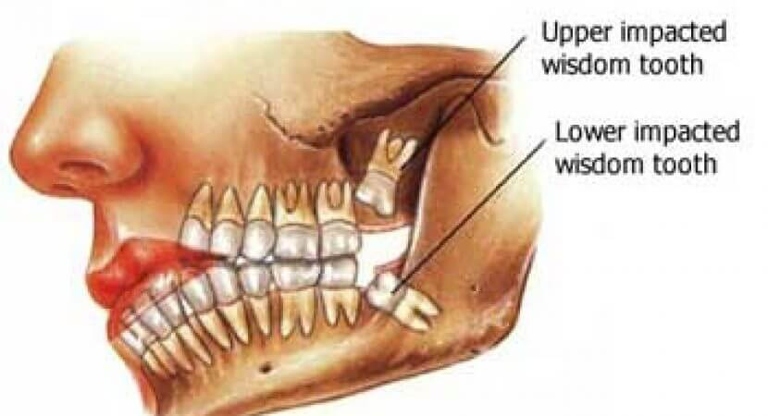 Most people have all four of their wisdom teeth, but they are often removed before they fully erupt.