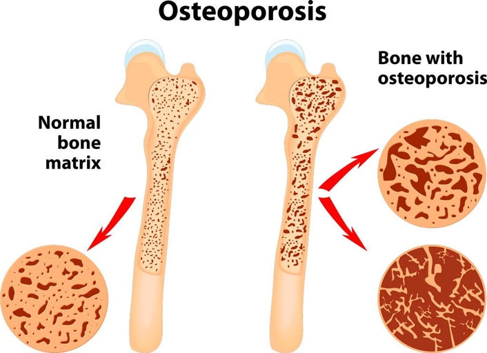 Osteoporosis is a disease that causes bones to become weak and break easily.