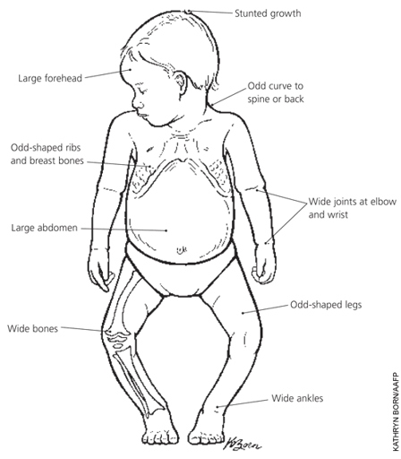 Rickets is a disease that can be caused by vitamin D deficiency.