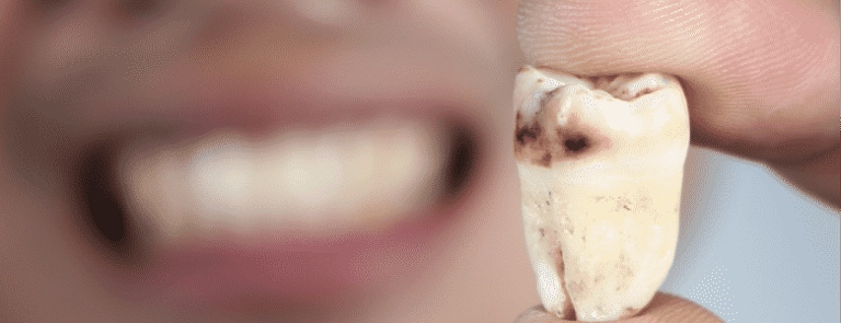 Tooth decay is a serious problem that can lead to a number of health problems.